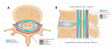 Epidural, Inadvertent Subdural, and Combined Epidural–Subdural ...