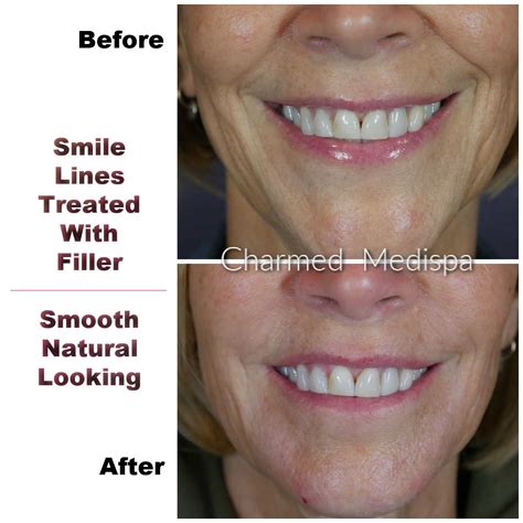 How To Reduce Lines By Mouth at Robbin Wood blog