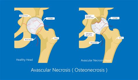 Avascular Necrosis (AVN) - Lymphoma Australia