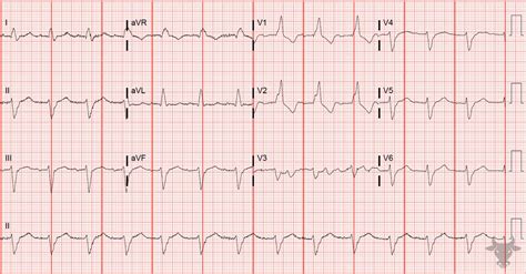 Left Anterior Fascicular Block | ECG Stampede
