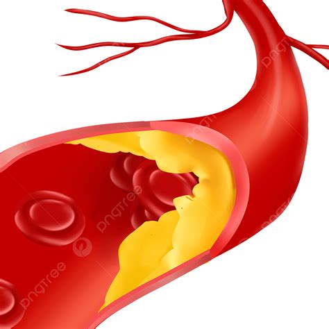 Vascular White Transparent, Vascular Occlusion Vascular Section ...