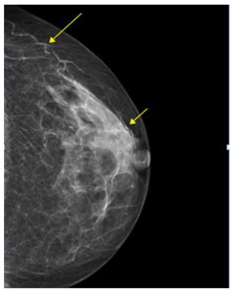 Detecting Breast Arterial Calcifications in Mammograms with Transfer Learning
