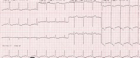 LVH on Echocardiogram
