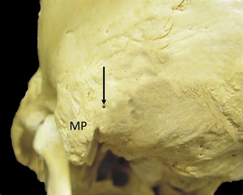 Process Bone 的图像结果