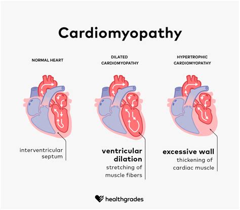 Cardiomyopathy: Symptoms, Causes, and Treatments