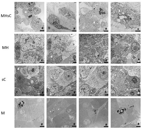 Local Magnetic Hyperthermia and Systemic Gemcitabine/Paclitaxel ...