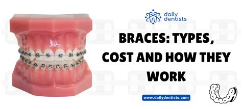 Braces: Types, Cost and How They Work - Daily Dentists