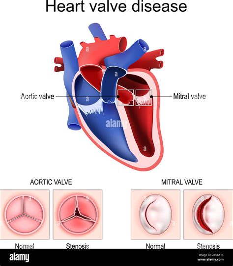 Mitral Valve Disease Diagram