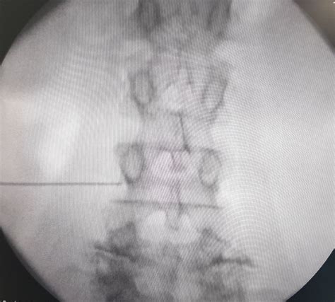 Injection procedures for spine problems – when and how? - MedSpine