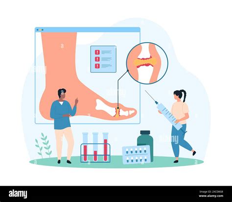 Diagnosis and treatment of gout, inflammatory arthritis of foot joints, rheumatology. Tiny ...