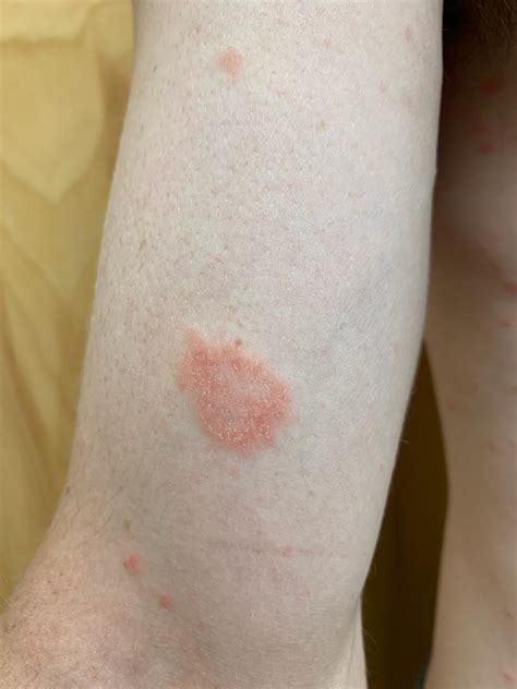 Image result for Rash Algorithm Pityriasis