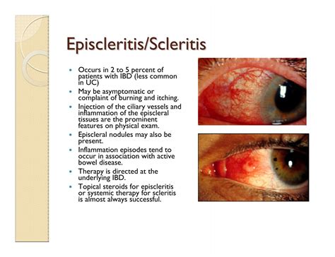 Scleritis Vs Episcleritis