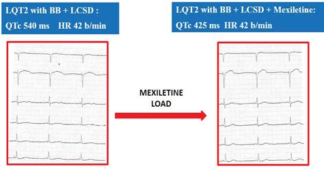 Therapeutic Efficacy of Mexiletine for Long QT Syndrome Type 2: Evidence From Human Induced ...