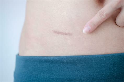 Close-up of scars after appendix surgery. 32484534 Stock Photo at Vecteezy