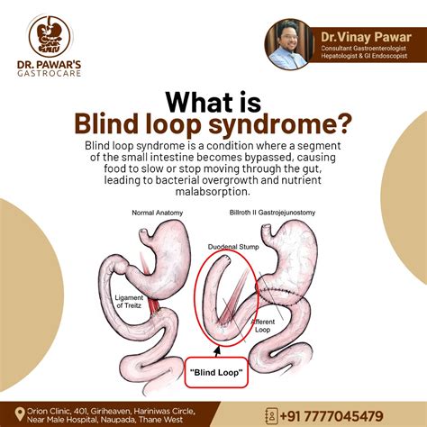 Blind Loop Syndrome