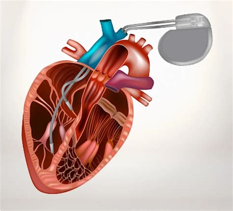 Image result for Installing Pacemaker