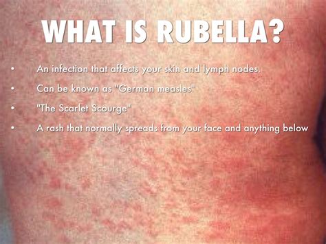 Bildergebnis für rubella symptoms
