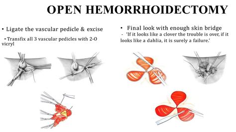 Hemorrhoidectomy surgical procedure RAF.pptx