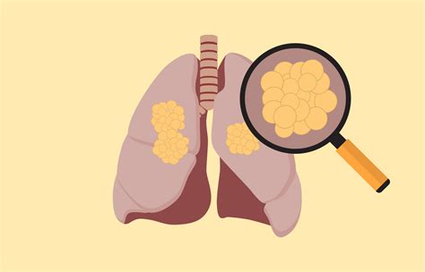 非小细胞肺癌的类型：哪种肺癌预后较好？哪种肺癌生长扩散的快？ - 知乎