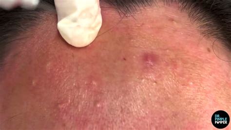 Exploding Zits and Boils 的图像结果