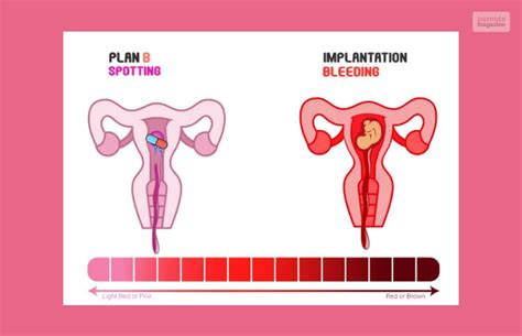 Plan B Spotting VS Implantation Bleeding: What's The Difference?