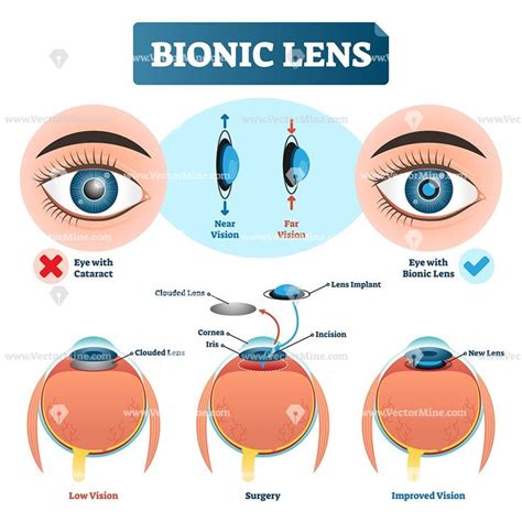 Image result for Bionic Eye Lens