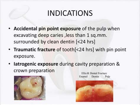 Image result for Direct Pulp Capping Vs RCT