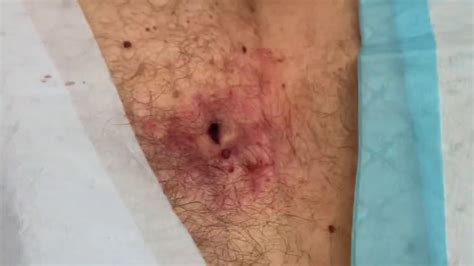 Image result for Giant Abscess Exploding On Back