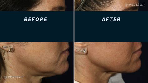 Image result for Sofwave Log