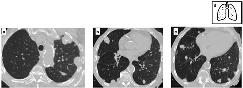 Calcified Lung Nodules: A Diagnostic Challenge in Clinical Daily Practice