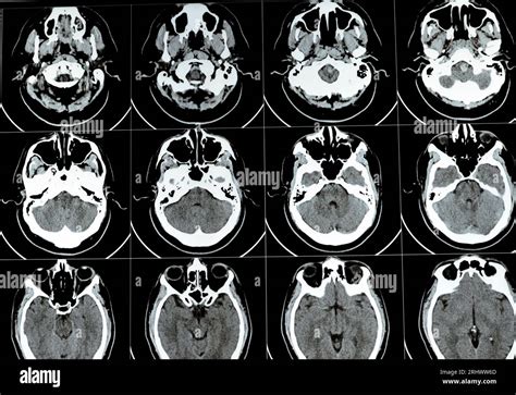 Brain CT Scan 的图像结果