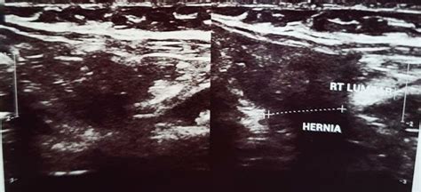 Image result for Undulation Defect