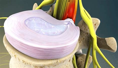 Bulging Disc Surgery 的图像结果