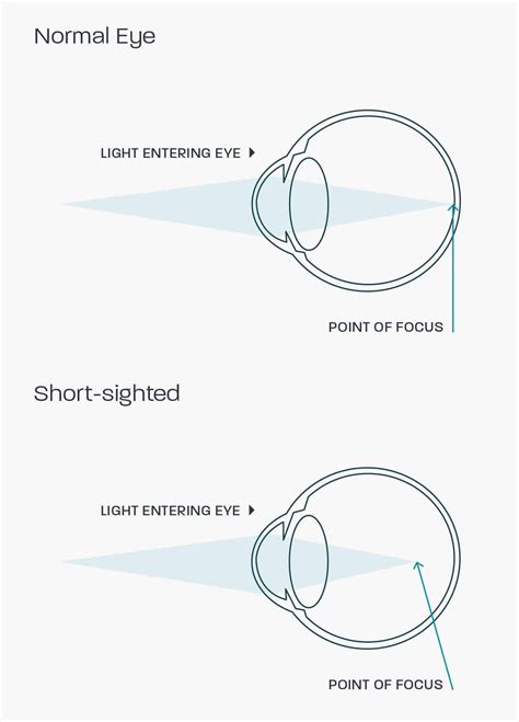 Myopia | Glasses Direct™