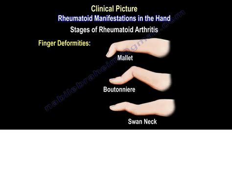 Rheumatoid Arthritis Early Symptoms In Hands at Henry Lymburner blog