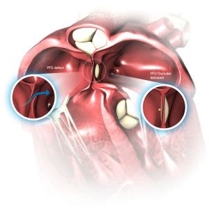 PFO Defect 的图像结果