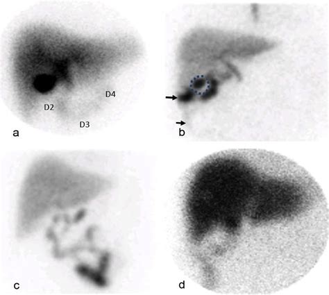 Understanding Hida Scan Results