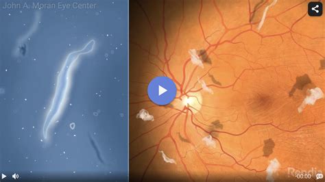 Vitreous Detachment & Vitreous Floaters | John A. Moran Eye Center | University of Utah Health