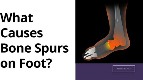 What Causes Bone Spurs on Foot? | Daily Care Blog