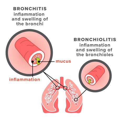 Bronchiolitis vs. Bronchitis: Symptoms, Causes, and Treatments