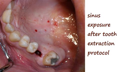 Image result for Problems After Tooth Extraction