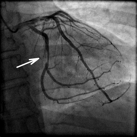 Ischämie und Ischämiediagnostik - Kardiologie & Gefäßmedizin ...