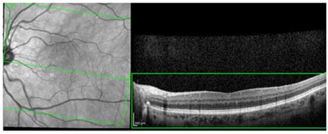 Diabetic Macular Edema Optical Coherence Tomography Biomarkers Detected ...