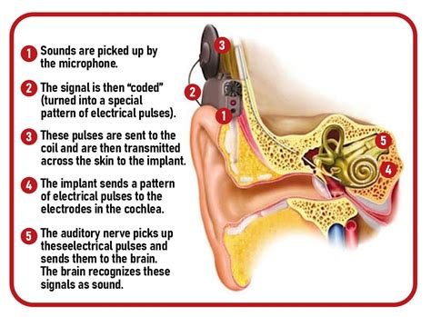 Is your child hearing right? Why cochlear implants for kids help them ...