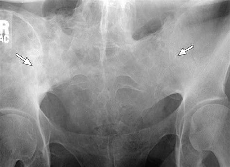 Interosseous Ligament Si Joint
