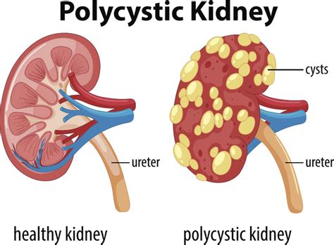 Polycystic kidney disease the most common genetic kidney disorder you ve probably never heard of ...