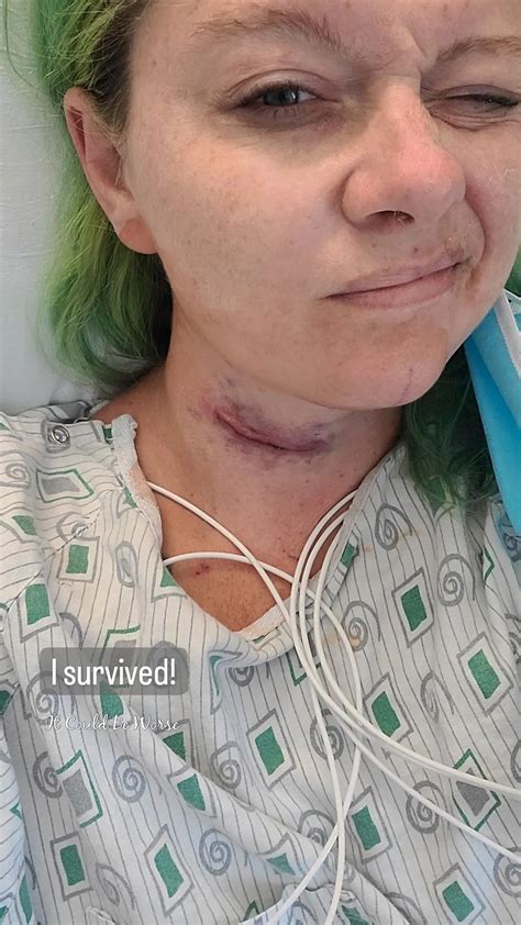 Anterior cervical discectomy and fusion – Artofit - anterior cervical discectomy