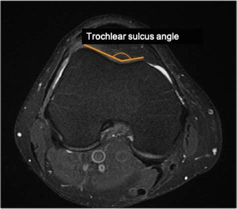 Patellar Tilt and Patellar Tendon–Trochlear Groove Angle Present the Optimum Magnetic Resonance ...