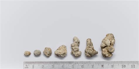 Identifying Kidney Stones