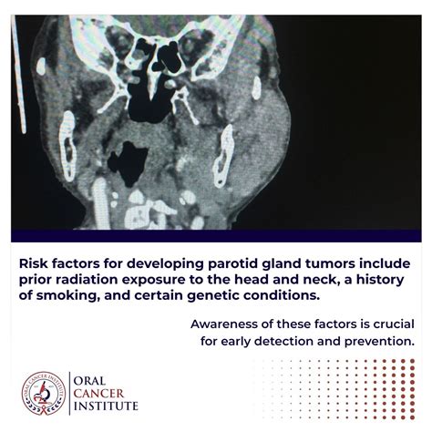 Oral Cancer Institute on LinkedIn: Parotid Gland Tumors